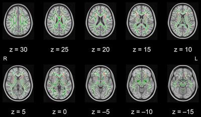 Tract-Based Spatial Statistics Analysis of Diffusion Tensor Imaging in Older Adults After the PICMOR Intervention Program: A Pilot Study